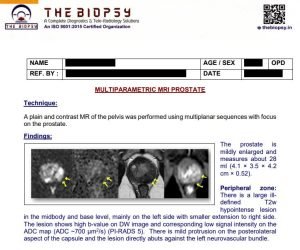 multiparametric mri prostate